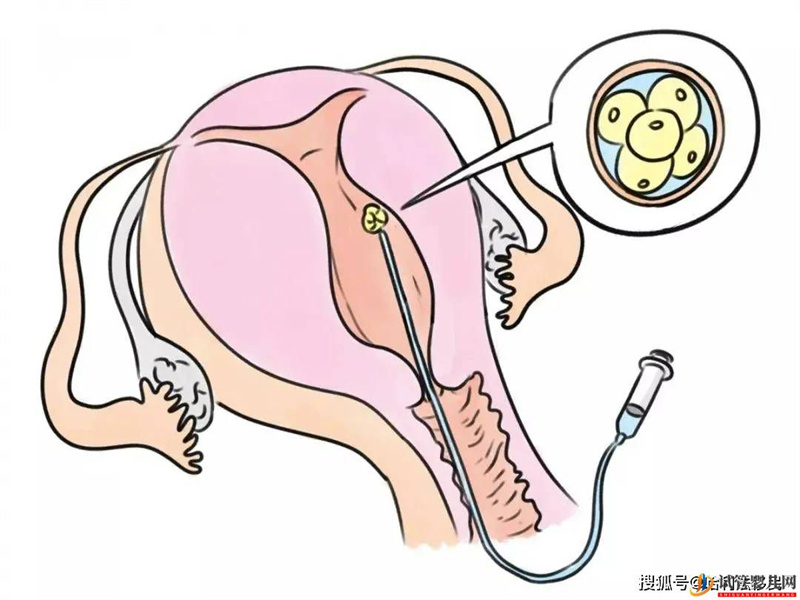 試管胚胎不是你想移植就能移，需要滿足這些條件！(圖1)