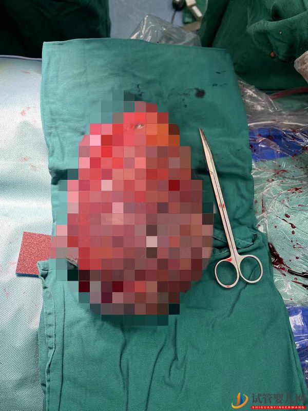 7斤2兩！女子高挺肚子像孕婦，醫生取出巨大腫瘤(圖2)