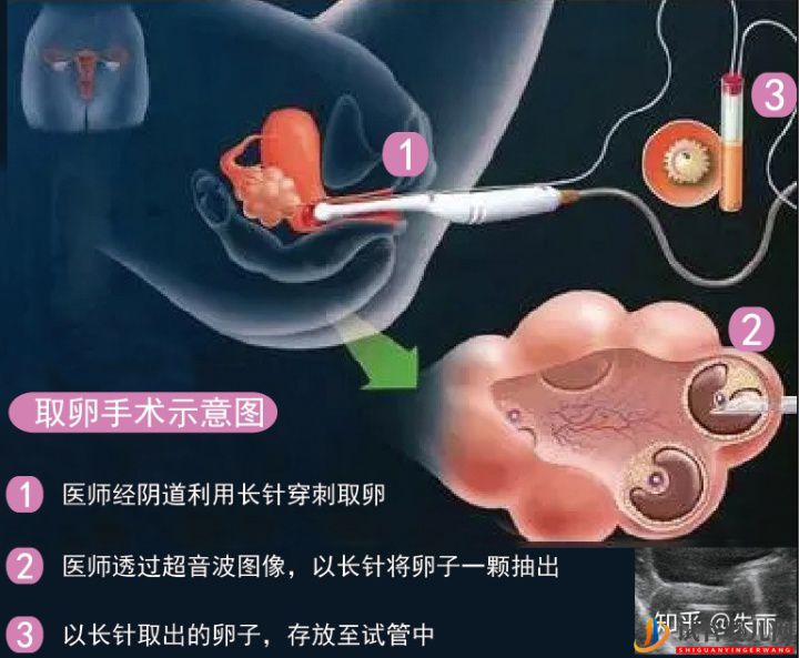 “取卵”手術全過程揭秘(圖1)