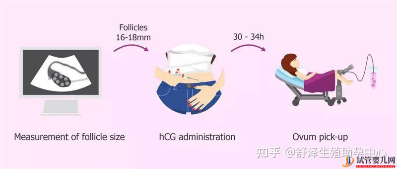 一個(gè)試管嬰兒周期多長(zhǎng)時(shí)間,具體流程怎么樣(圖5) 一個(gè)試管嬰兒周期多長(zhǎng)時(shí)間,具體流程怎么樣(圖5)