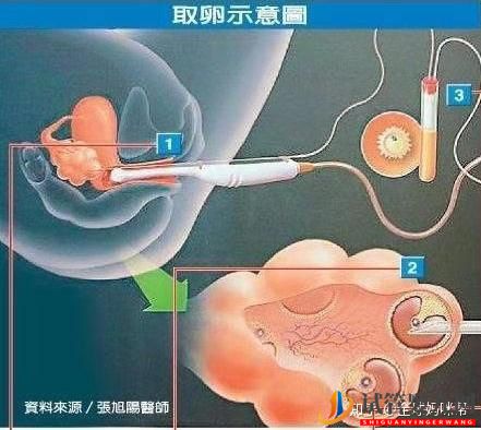烏海試管嬰兒是怎么做的_一分鐘帶你看懂全過程(圖7)