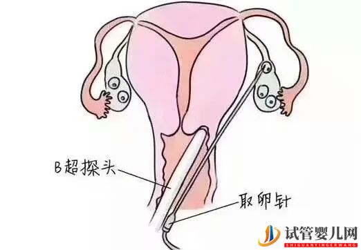 一文讀懂試管嬰兒全過程(圖5)