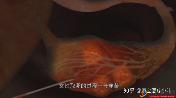 做試管嬰兒有多痛,幾張3D模擬圖,看完全過程后心(圖2) 做試管嬰兒有多痛,幾張3D模擬圖,看完全過程后心(圖2)