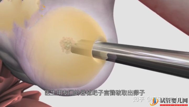 做試管嬰兒有多痛,幾張3D模擬圖,看完全過程后心(圖3) 做試管嬰兒有多痛,幾張3D模擬圖,看完全過程后心(圖3)