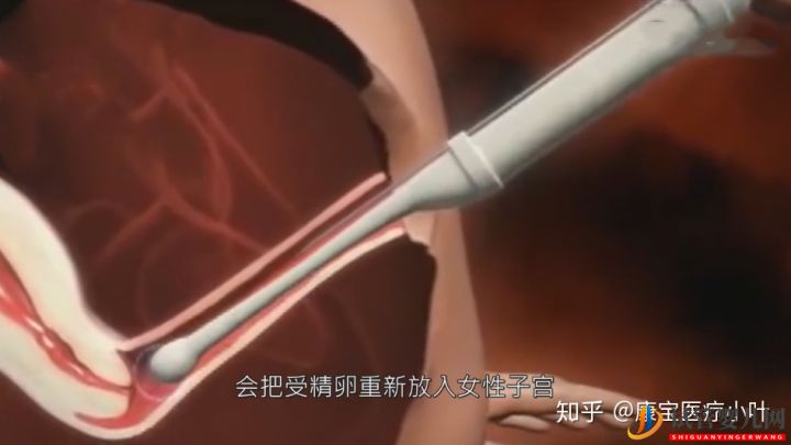 做試管嬰兒有多痛,幾張3D模擬圖,看完全過程后心(圖8) 做試管嬰兒有多痛,幾張3D模擬圖,看完全過程后心(圖8)