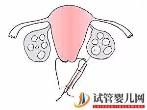 試管嬰兒取卵后為什么會(huì)腹痛？試管取卵后腹部疼痛怎么處理？(圖1)