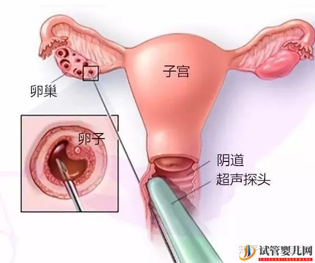取卵真的特別疼嗎(圖4)
