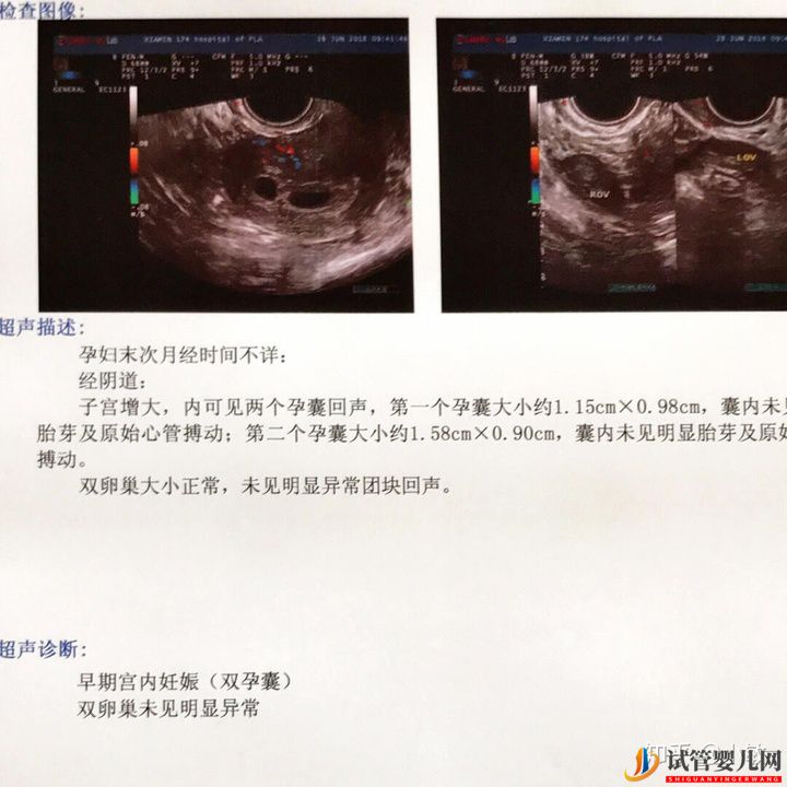 感覺很多人做試管生的都是兒子(圖5) 感覺很多人做試管生的都是兒子(圖5)