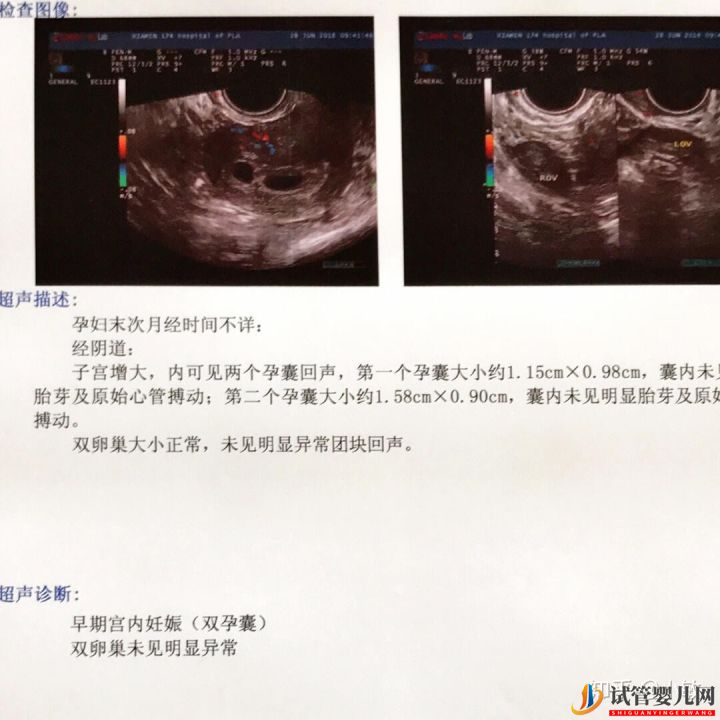 感覺很多人做試管生的都是兒子(圖6) 感覺很多人做試管生的都是兒子(圖6)