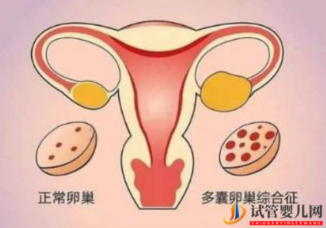 多囊卵巢綜合征對(duì)試管嬰兒有什么影響(圖1)