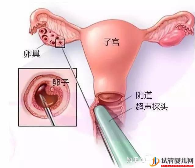 試管的時候,取卵痛嗎(圖1)