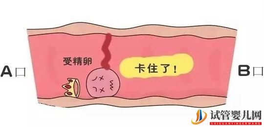 輸卵管堵塞還想懷寶寶!能夠做泰國試管嬰兒嗎(圖3) 輸卵管堵塞還想懷寶寶!能夠做泰國試管嬰兒嗎(圖3)
