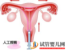 不孕，試管嬰兒和人工授精應(yīng)該選擇哪一個(gè)？(圖4)