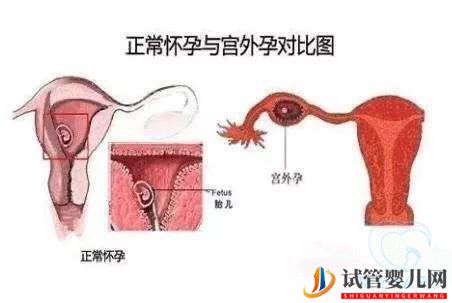 做試管嬰兒宮外孕會發(fā)生嗎？做試管嬰兒能不能避免宮外孕(圖2)