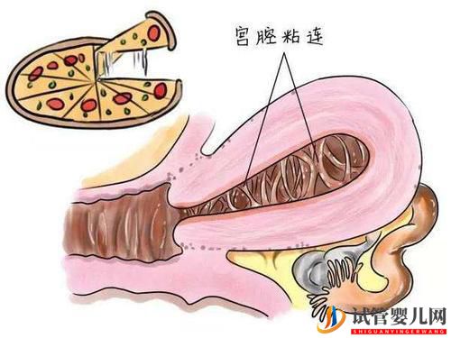 子宮粘連可以做試管嬰兒嗎？成功率高不高？(圖1)