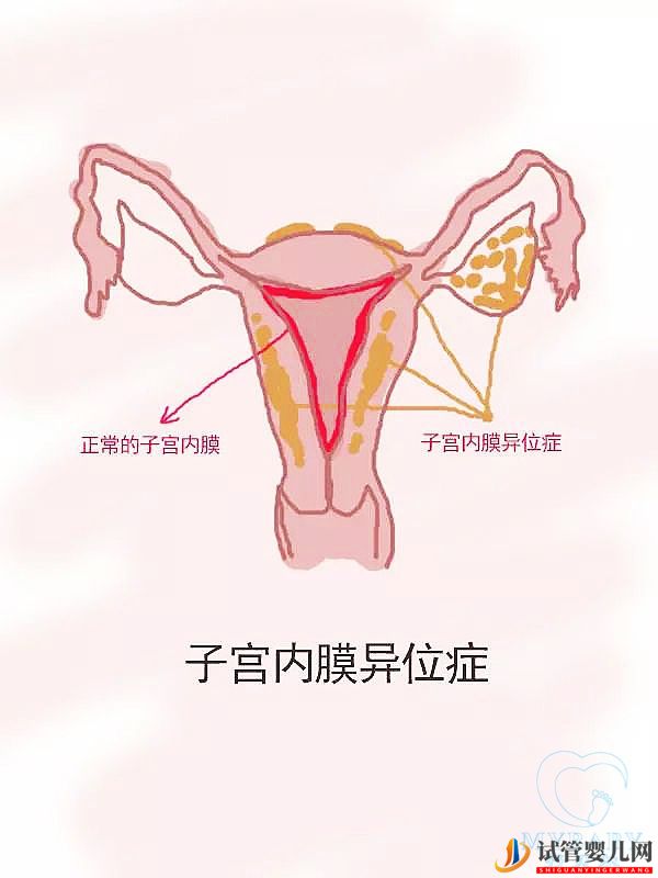 子宮內膜異位癥試管嬰兒成功率高嗎？(圖1)