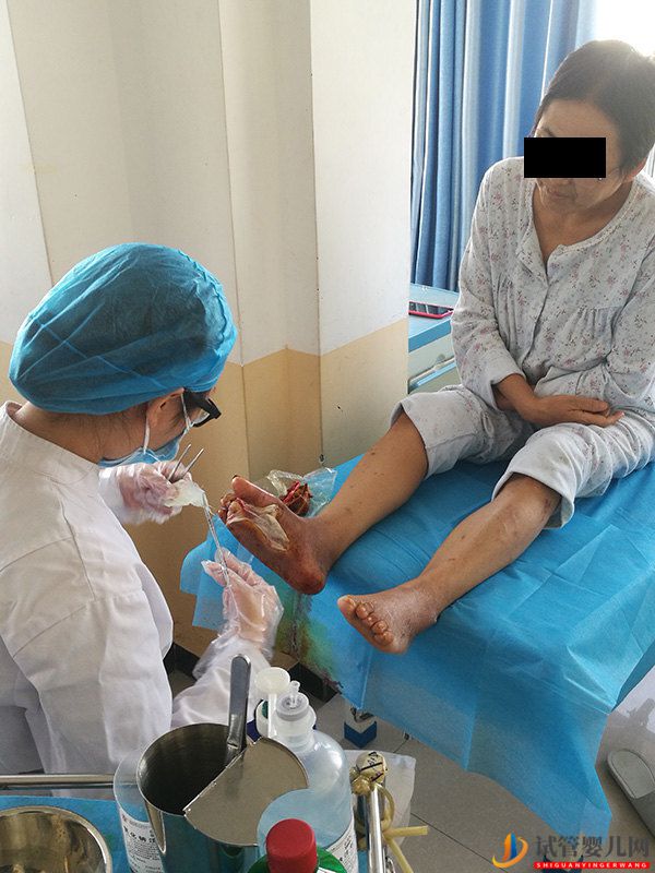 糖尿病并發(fā)癥糖尿病足到底有多可怕，可以避免截肢嗎？(圖1)