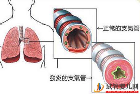 四川哪家醫(yī)院治療慢性支氣管炎效果好(圖1)
