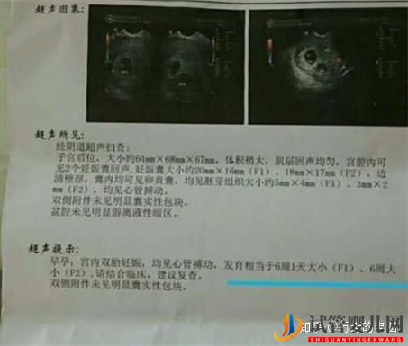 一個高齡婦女的試管之路(圖4)