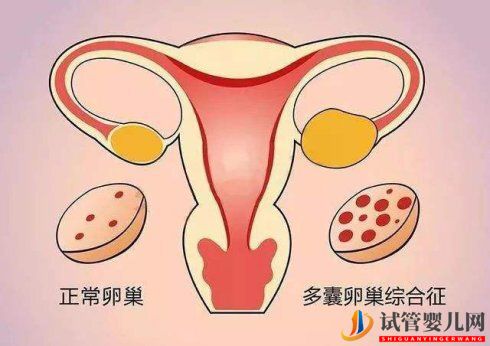 試管取卵后怎么解決卵巢過度刺激綜合癥(圖1)