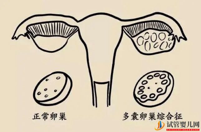 造成多囊卵巢的原因有哪些(圖1)