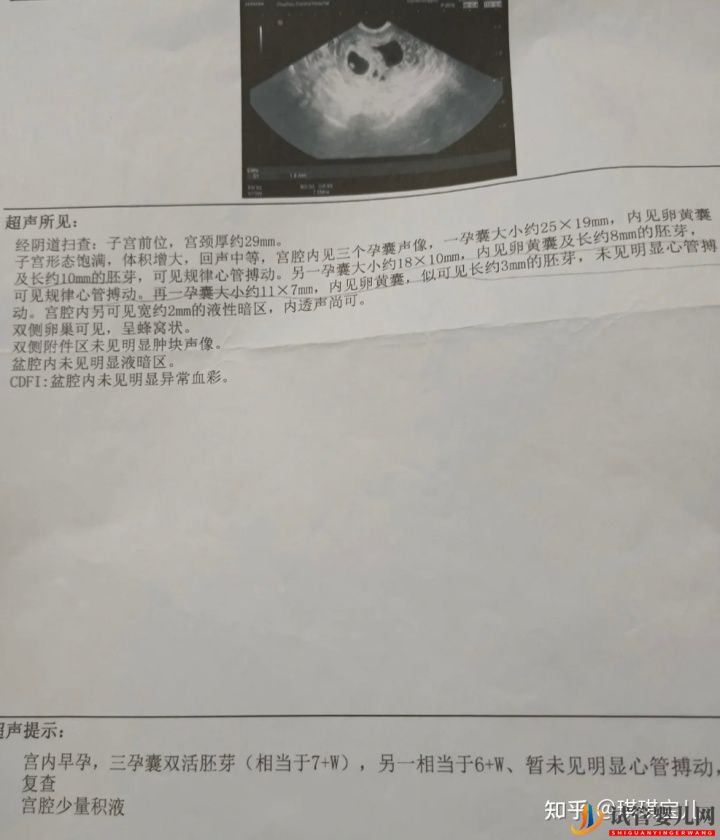 試管一次性成功,喜迎雙胎超順利(圖4)