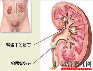 治療腎結石的費用大概需要多少錢？(圖1)
