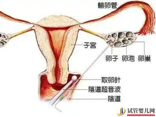 在醫院做試管取卵時使用的雙腔取卵針有多貴？(圖1)