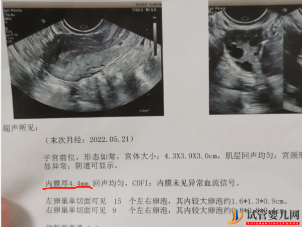 子宮內膜厚4.4mm狀態正常也別急！移植最佳厚度還沒到(圖2)