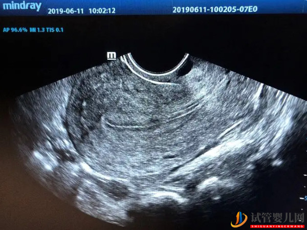 子宮內膜厚4.4mm狀態正常也別急！移植最佳厚度還沒到(圖3)