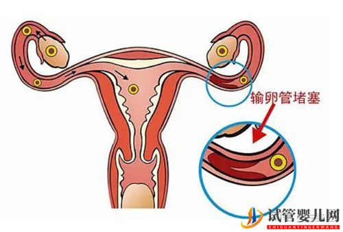 美國試管嬰兒如何助孕輸卵管性不孕(圖1)