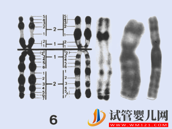 6號染色體缺失、重復相關(guān)疾病匯總，不同異常對寶寶影響不一(圖1)