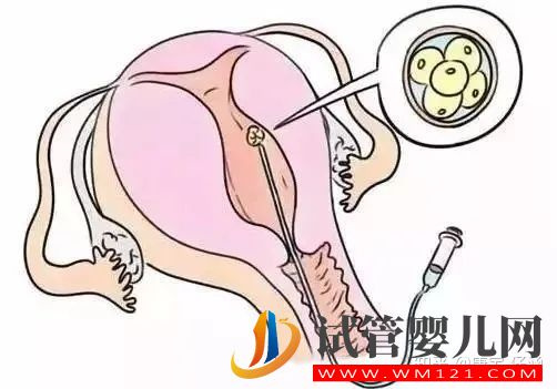云浮試管嬰兒有關(guān)“胚胎移植”的問(wèn)題解答(圖1)
