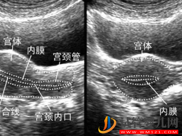 薄型子宮內膜臨床表現和診斷標準匯總，及時發現避免不孕(圖1)