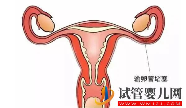 你了解輸卵管阻塞嗎?原因/癥狀/影響(圖1) 你了解輸卵管阻塞嗎?原因/癥狀/影響(圖1)