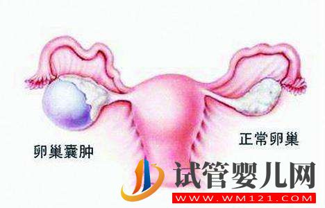 卵巢囊腫會引起卵巢衰退嗎？(圖1)