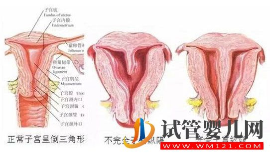 帶你了解什么是縱膈子宮，別再和雙子宮搞混了(圖2)