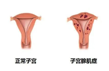 我有子宮腺肌癥,可以做試管嬰兒嗎?(圖1) 我有子宮腺肌癥,可以做試管嬰兒嗎?(圖1)