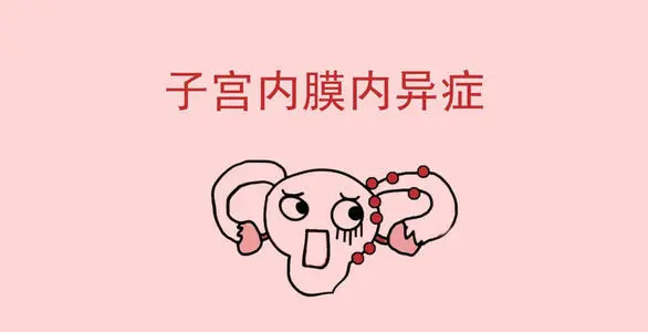 子宮內(nèi)膜異位癥,是卵巢癌的主要元兇?(圖1) 子宮內(nèi)膜異位癥,是卵巢癌的主要元兇?(圖1)