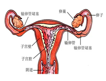 輸卵管堵塞的原因是什么,能徹底根治嗎?(圖1) 輸卵管堵塞的原因是什么,能徹底根治嗎?(圖1)