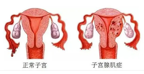 子宮腺肌癥能去跟嗎?有效的治療方案大全(圖1) 子宮腺肌癥能去跟嗎?有效的治療方案大全(圖1)