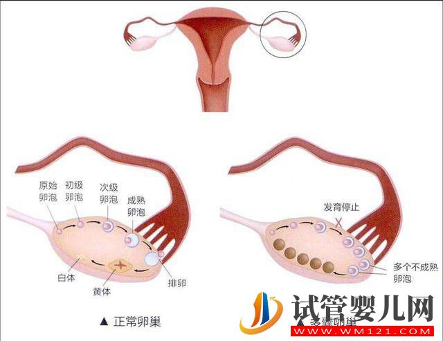 多囊卵巢綜合征是怎樣的一種疾病?(圖1) 多囊卵巢綜合征是怎樣的一種疾病?(圖1)