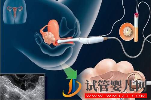 人工授精和試管嬰兒的區別及手術費用是多少?(圖2) 和田人工授精和試管嬰兒的區別及手術費用是多少?(圖2)