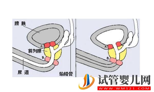 逆行射精可以做試管嬰兒?jiǎn)幔?圖1) 逆行射精可以做試管嬰兒?jiǎn)幔?圖1)