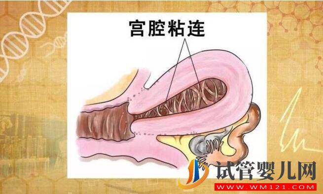 宮內粘連會影響到試管嬰兒嗎?(圖1) 宮內粘連會影響到試管嬰兒嗎?(圖1)