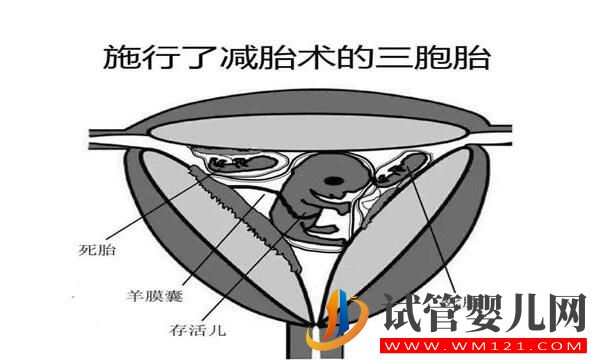 試管嬰兒減胎術在哪些情況下使用 要注意哪些(圖2) 試管嬰兒減胎術在哪些情況下使用 要注意哪些(圖2)