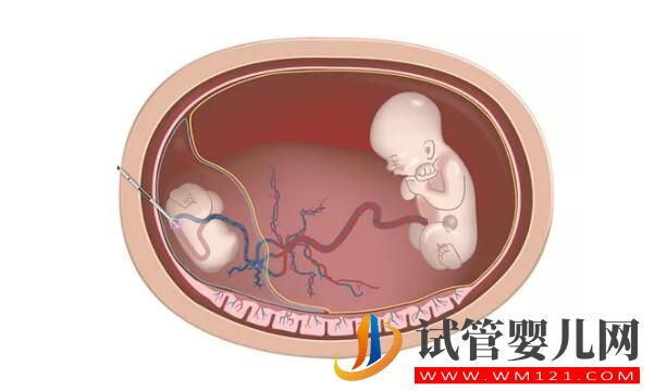 試管嬰兒減胎術在哪些情況下使用 要注意哪些(圖1) 試管嬰兒減胎術在哪些情況下使用 要注意哪些(圖1)