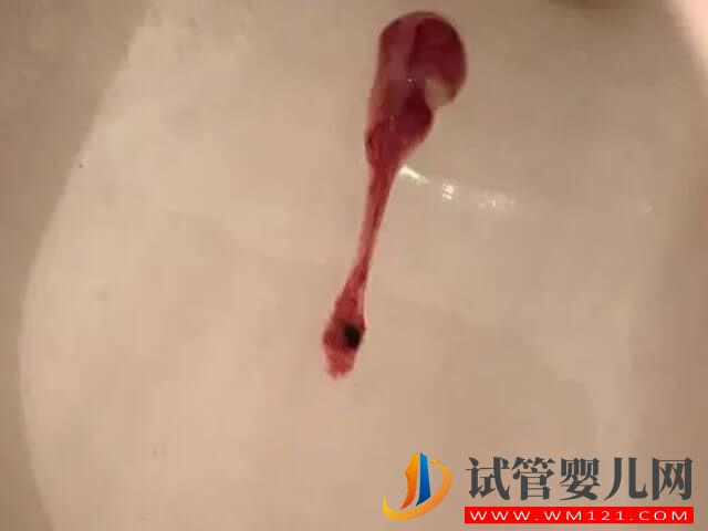喀什移植第23天晚上突然出少量鮮血能保住嗎？(圖1)
