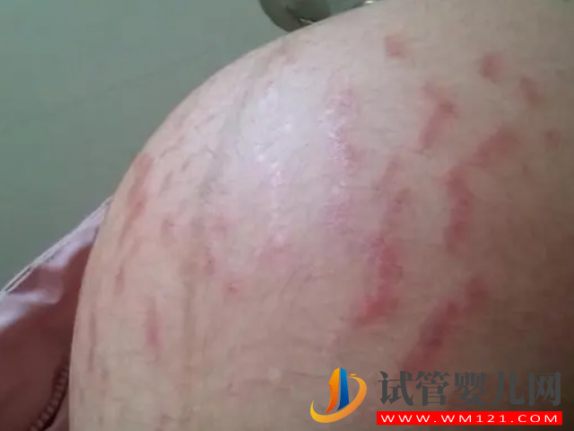 妊娠線粗細、長短都已暗示生男生女，不同性別區(qū)別真的很大(圖2)