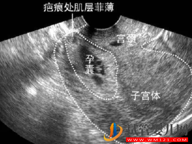 二胎38周剖腹產后遺癥太多！產后每天都在后悔(圖2)